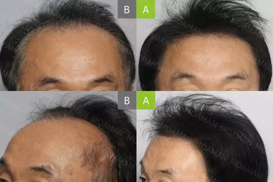Slider image (6) MOAMAN Hair Transplant Clinic